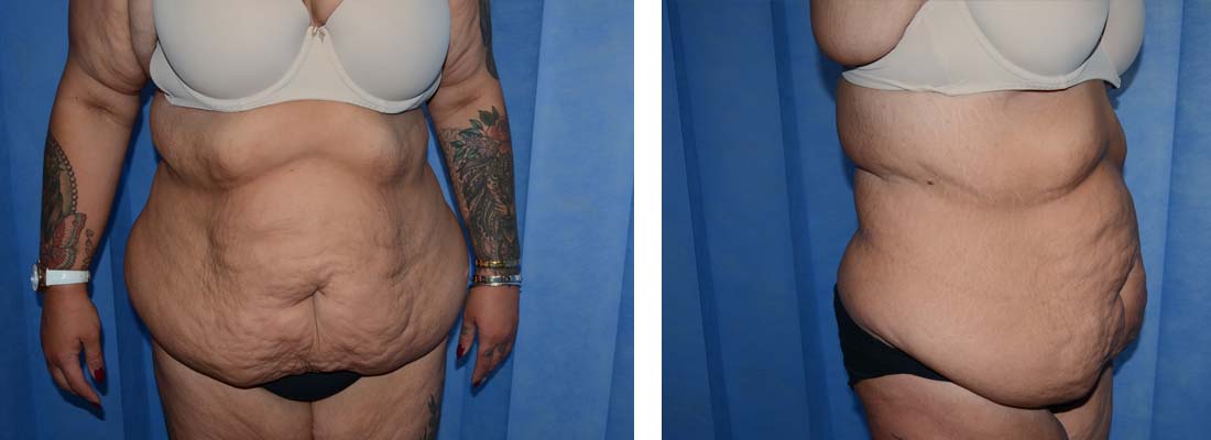 Laura Tummy Tuck